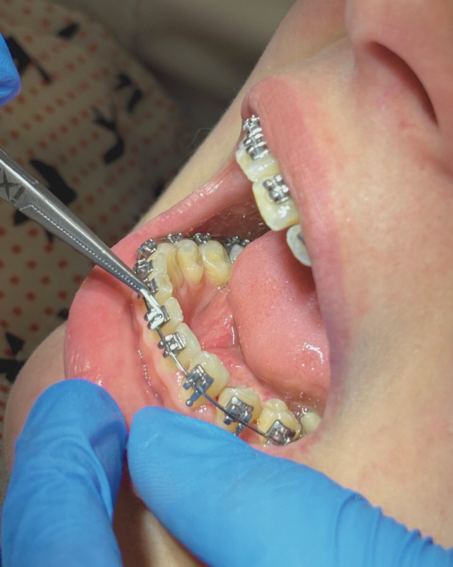 slika otvorenih usta sa breketima i žicama